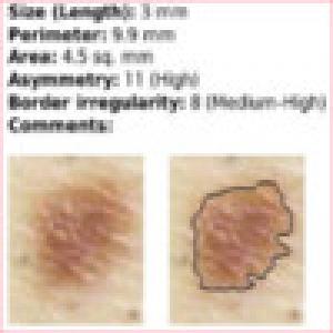  Skin Mole Analysis (2009). Нажмите, чтобы увеличить.